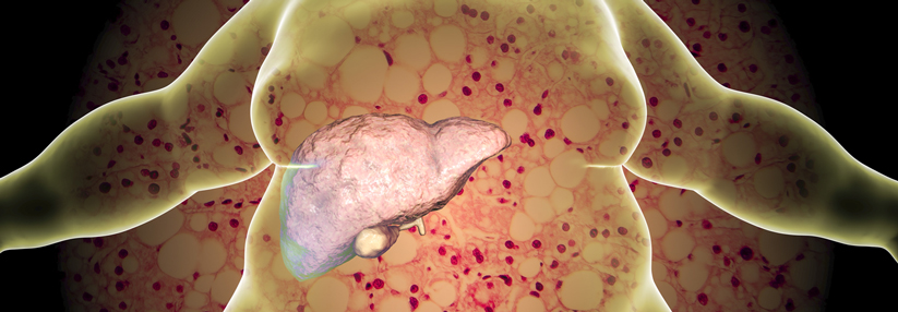 Steatosis hepatis lässt sich mit K77.8* und als Manifestation/Komplikation des Diabetes kodieren.