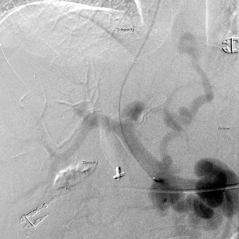 Platzierung des Führungsdrahtes in der V. mesenterica inferior mit erneuter Lagekon­trolle und Messung des Lebervenendruckgradienten (ca. 24 mmHg)