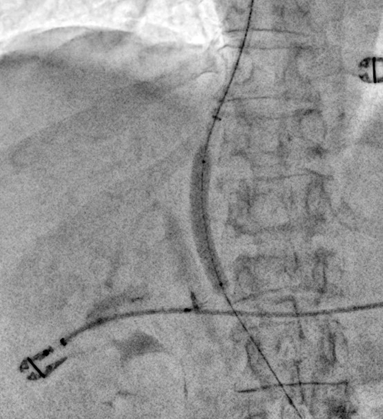 Vordehnung durch einen Angioplastie-Ballon
