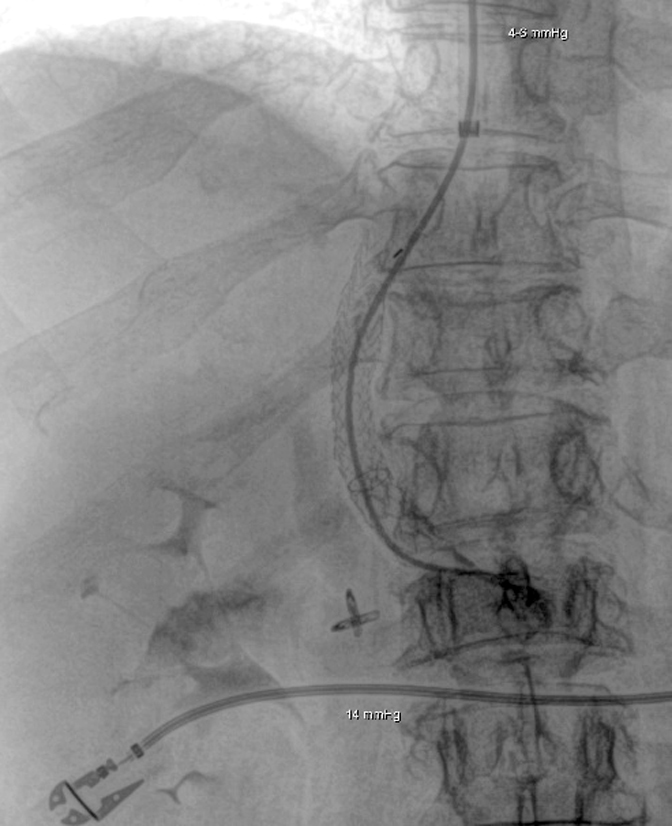 Darstellung des eingebrachten Stents. Die erneute Messung des Lebervenendruckgradienten ergibt einen Wert von ca. 10 mmHg.