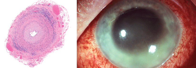 Die Riesenzellarteriitis (links) betrifft vor allem bei Älteren die Schläfenarterien und kann zur Erblindung führen. Rechts: Nicht mit einer Bindehautentzündung verwechseln! Die Iritis gefährdet das Augenlicht. 