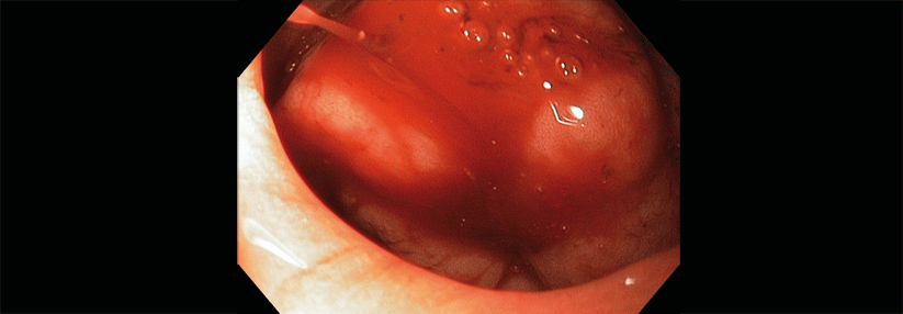 Sickerblutungen (Forrest Ib) wie diese im Duodenum haben ein hohes Risiko für Rezidivblutungen.