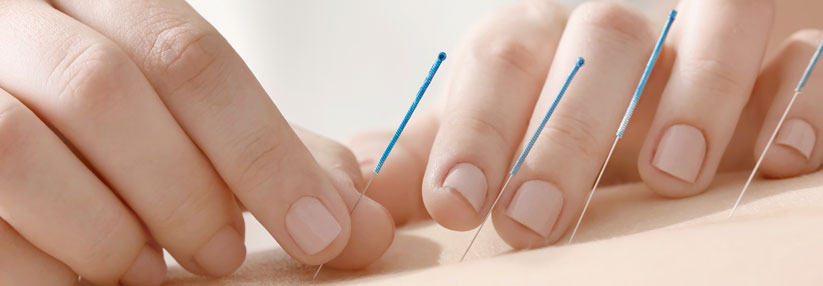 Schmerzen aufgrund einer Chemotherapie können durch Akupunktur gemindert werden.