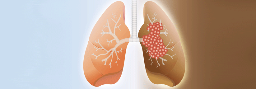 Eine aktualisierte Auswertung bestätigt den Überlebensvorteil für Patienten mit kleinzelligem Lungenkrebs.