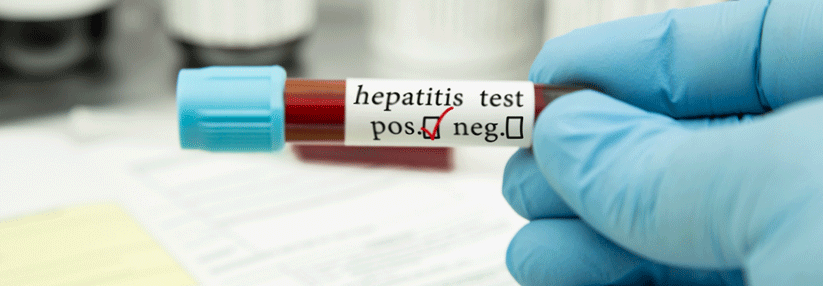 Sinnvoll wäre es, zusammen mit dem Test auf Corona den Patienten gleichzeitig auch auf Hepatitis C zu untersuchen.