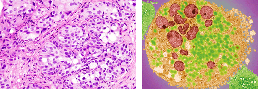 Links: Urothelkarzinom der Blase. Rechts: Elektronenmikroskopische Aufnahme einer Krebszelle der Blase. Die Mehrheit der Teilnehmer hatte dort den Primärtumor.