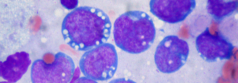 B-Lymphoblasten (lila-blau) und Makrophagen (weiß) bilden den für das Burkitt-­Lymphom typischen „Sternenhimmel“ in der Histologie. Der rasant wachsende Tumor spricht i.d.R. gut auf die Chemo an.