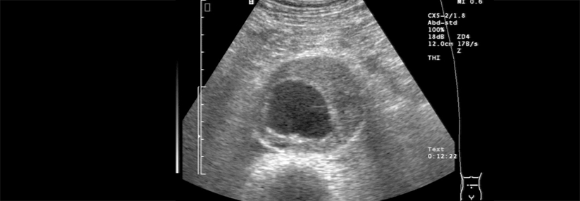 Per Sono ist ein Bauchaortenaneurysma zwar gut zu erkennen. Bei atypischen Symptomen wird sie aber kaum genutzt.