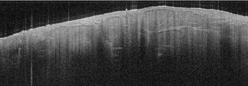 Die OCT geht unter die Haut und das auch ohne invasiven Eingriff.