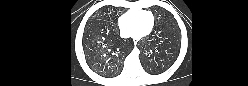 Die Bronchiolitis obliterans gilt nach der Stammzelltransplantation als späte pulmonale Komplikation.