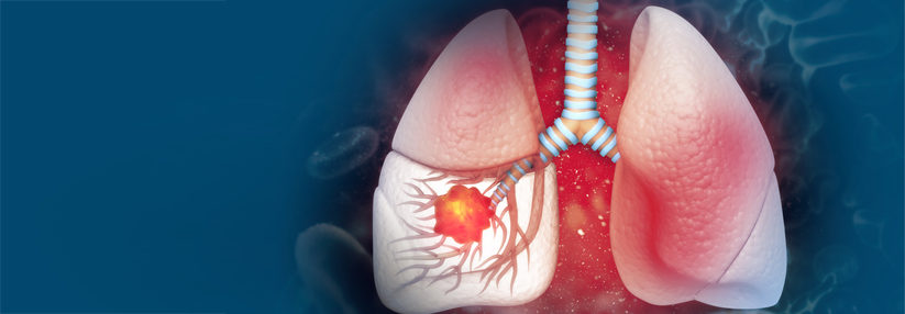 Cemiplimab ist nicht nur beim Plattenepithelkarzinom wirksam, sondern auch beim metastasierten  nicht-kleinzelligen Lungenkarzinom.