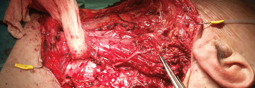 Fällt die pathologische Untersuchung der bei der Dissektion gewonnenen Lymphknoten negativ aus, dürfte der Patient von einer Bestrahlung keinesfalls profitieren.