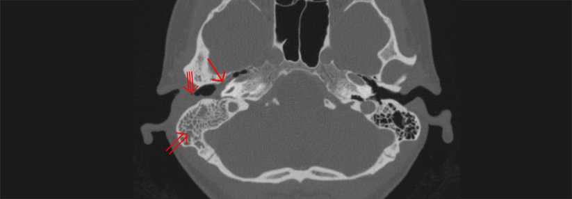 Bei einer Mastoiditis (links im Bild, Doppelpfeil) kann es zu lebensbedrohlichen intrakraniellen Komplikationen kommen.