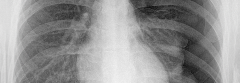 Wird beim Spontanpneumothorax eine Thoraxdrainage gelegt, kommt es in 20–35 % der Fälle zum Rezidiv.
