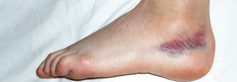 Fuß gipsschiene Patientenmerkblatt „Bänderriss