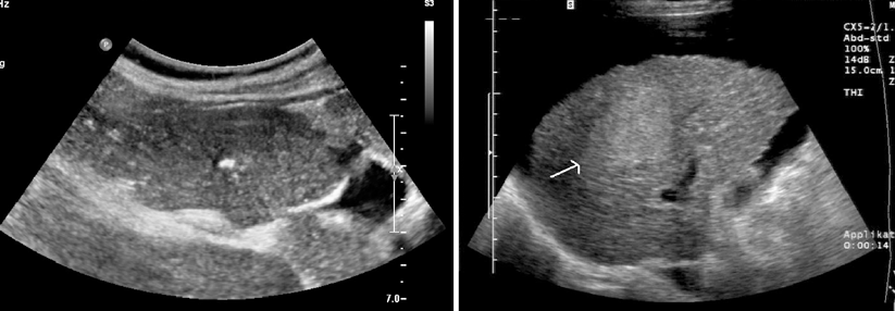 Links: Die fokal noduläre Hyperplasie erscheint als echoarme Raumforderung, in diesem Fall mit zentraler echoreicher Narbe. Rechts: In 9 von 10 Fällen entsteht ein hepatozelluläres Karzinom im Rahmen einer Zirrhose.