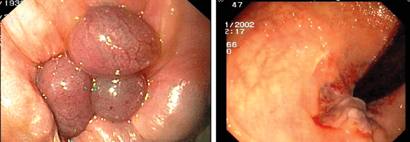 Die Gummibandligatur (links) erfolgt ambulant und ohne Anästhesie. Nach etwa sieben bis zehn Tagen fallen die Knoten ab (rechts).