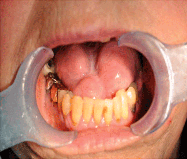 Durch die Behandlung erholte sich die Zunge, büßte aber an Beweglichkeit ein.