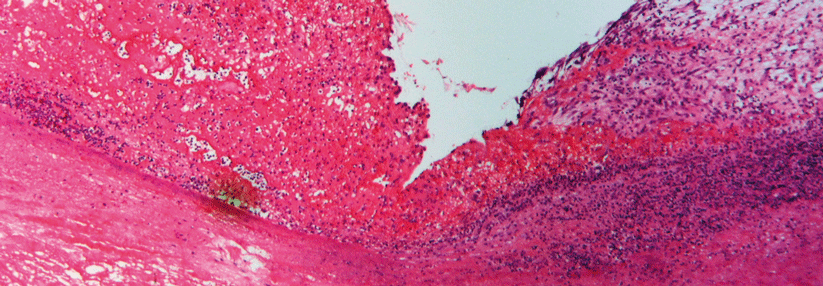Degenerative Klappenleiden erhöhen das Endokarditisrisiko. Dieses Beispiel zeigt eine fibrinös-ulzeröse Entzündung der Aortenklappe.