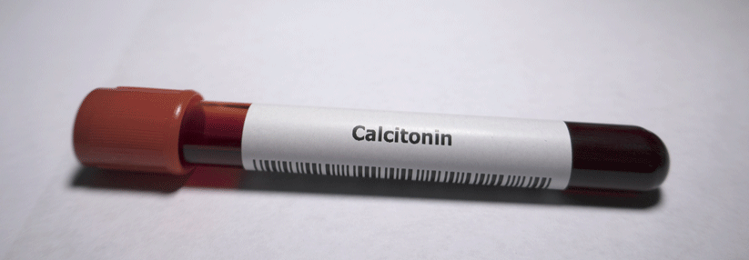 Nicht immer kommt ein erhöhter Calcitonin-Spiegel von einem Schilddrüsentumor.