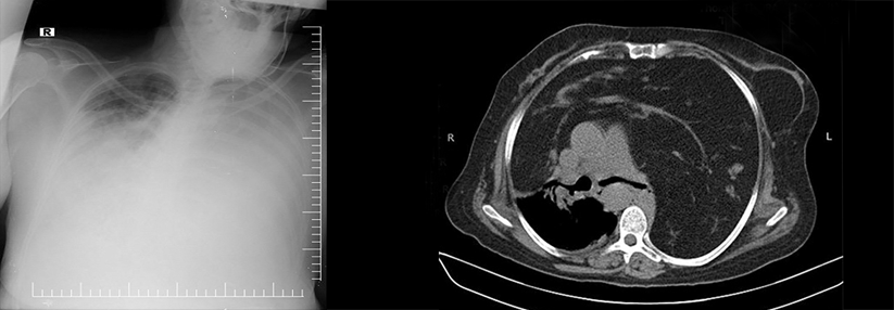 Im Thoraxröntgen deutete zunächst vieles auf ein Lungenödem (links). Erst die CT offenbarte eine große dichte retrosternale Masse (rechts).