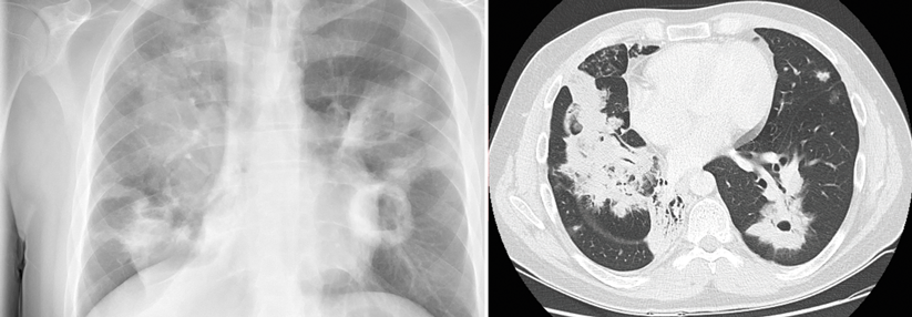 Im Röntgenbild links stellt sich neben dichten Infiltraten eine Kaverne im linken Unterfeld dar. Das Thorax-CT rechts zeigt ein Infiltrat im Mittellappen und einen Hohlraum, der von einem Infiltrat umgeben wird, im linken Unterlappen.