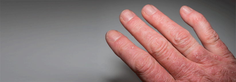 Bei einer Psoriasisarthritis leidet nicht nur die Haut, sondern auch die Gelenke. (Agenturfoto)