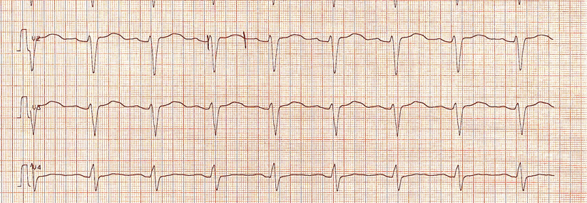 Ein genauerer Blick auf das EKG kann schon Aufschluss geben.