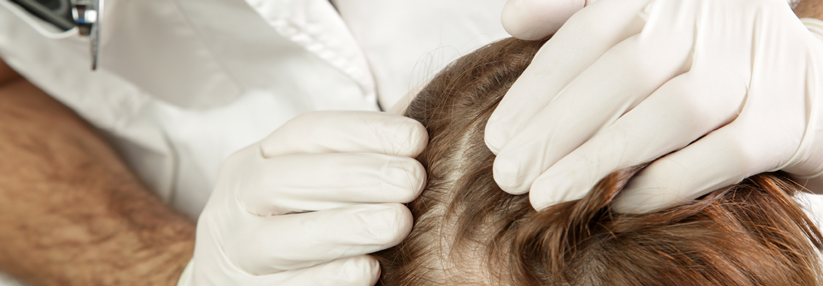 Wie Sie mit Alopeziepatienten am besten umgehen Viele Betroffene bringt sogar völlig regulärer Haarverlust aus der Ruhe.