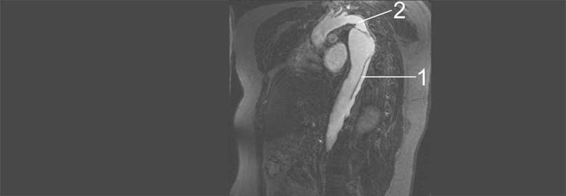 Nicht immer treten die für eine Aortendissektion typischen Zeichen auf. 1: Aorta descendens mit Dissektion. 2: Aortenisthmus.