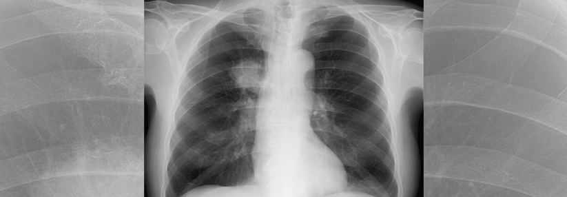 Der Herd in der rechten Lunge entpuppte sich als Bronchialkarzinom. (Agenturfoto)