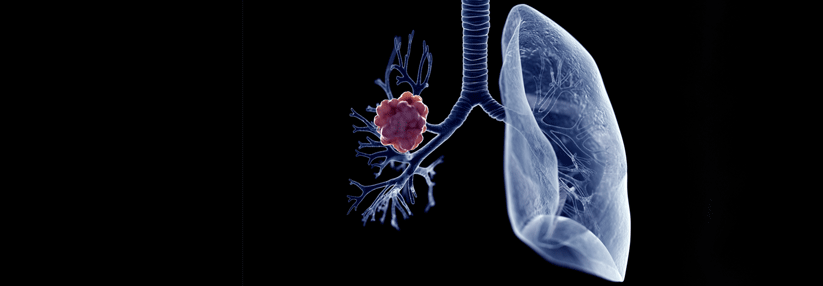 Bei nicht-kleinzelligen Lungentumoren können aktivierende ALK-Translokationen auftreten. Diese findet man bei etwa 3–5 % der Karzinome.
