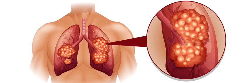 Patienten mit hoher PD-L1-Expression profitierten besonders.