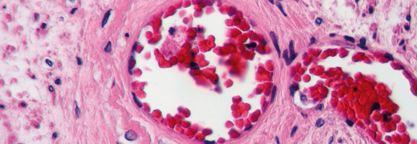 Um Gefäßthromben zu vermeiden, brauchen PAVK-Patienten einen Plättchenhemmer.