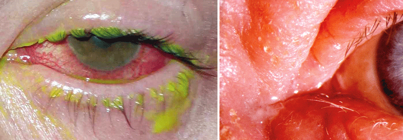 Die gefährlichste Komplikation, das Hornhautulkus (links), trifft vor allem Immunsupprimierte. Das Kontaktlinsenpflegemittel kann eine allergische Blepharitis (rechts) auslösen.
