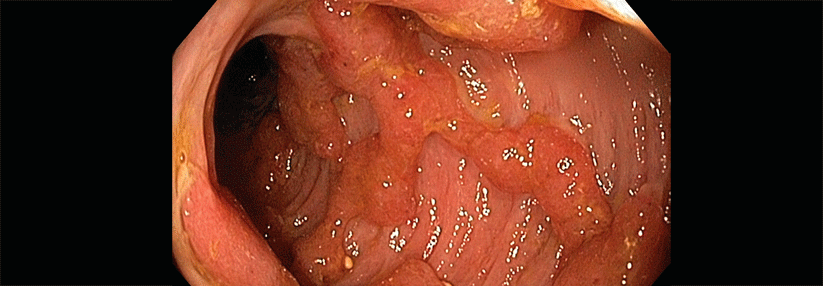 Die Entzündungen in der Schleimhaut im Rahmen einer Colitis ulcerosa begünstigen offenbar die Entartung von Zellen.