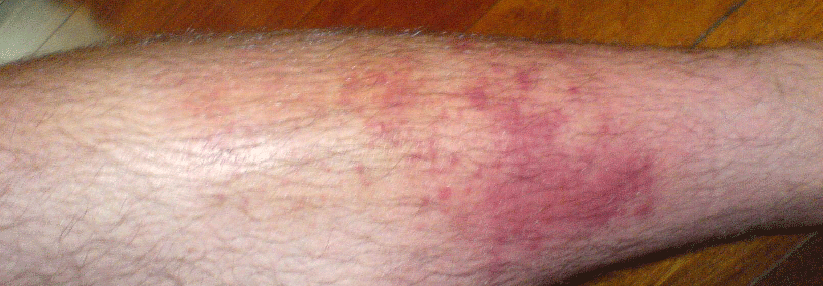 Punkte oberschenkel rote Glatte Beine
