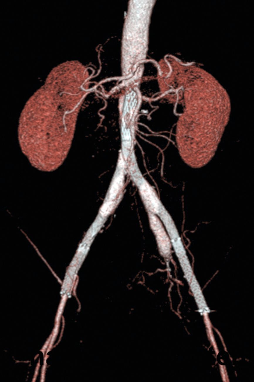 Abb. 1: Aortoiliakale Okklusion durch eine besondere Variante der PAVK, das Leriche-Syndrom. Mit der endovaskulären Behandlung gelang die Wiedereröffnung der Gefäße (danach). 