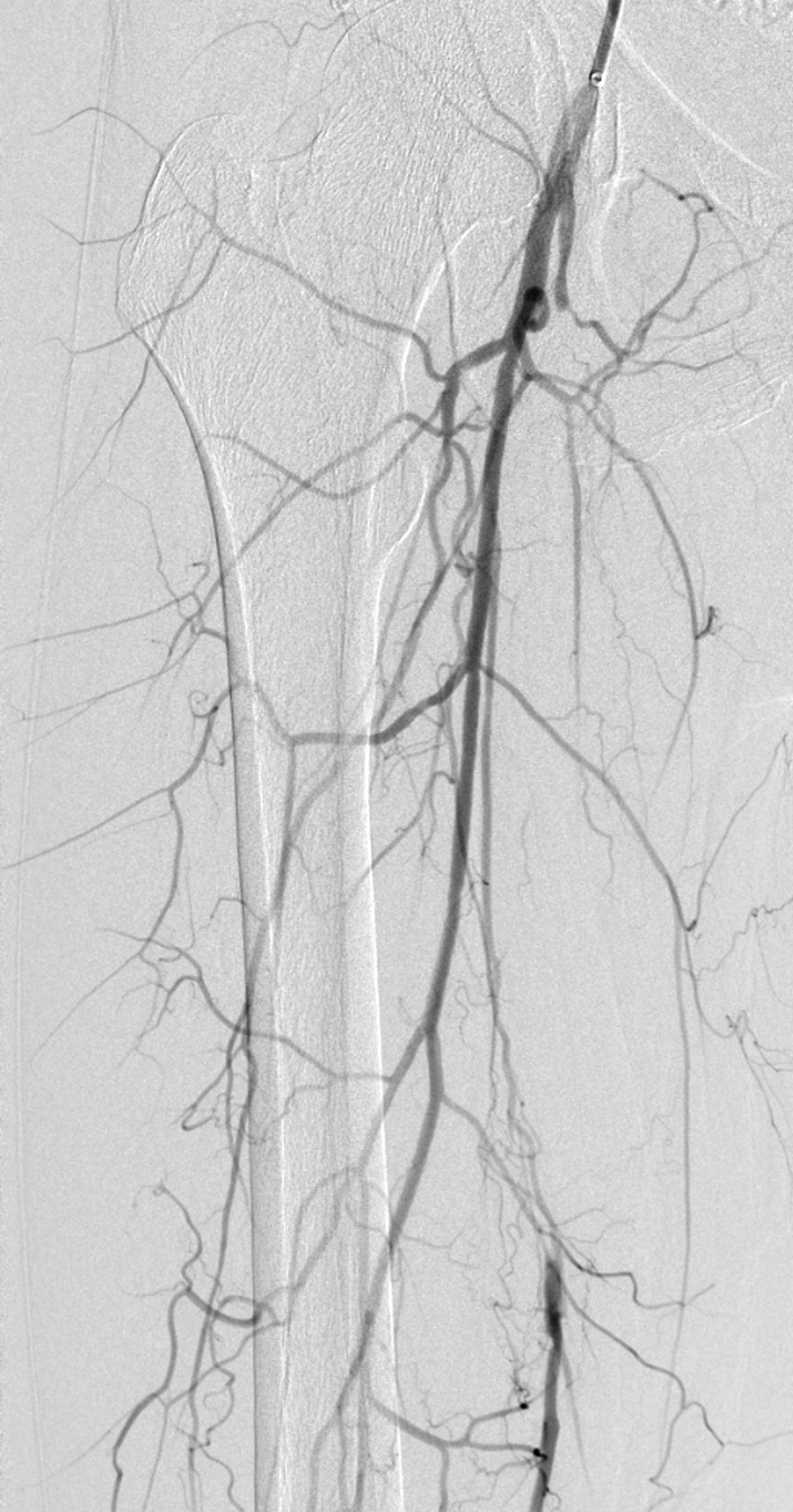 Abb. 2: Langstreckiger Verschluss der A. femoralis superficialis.