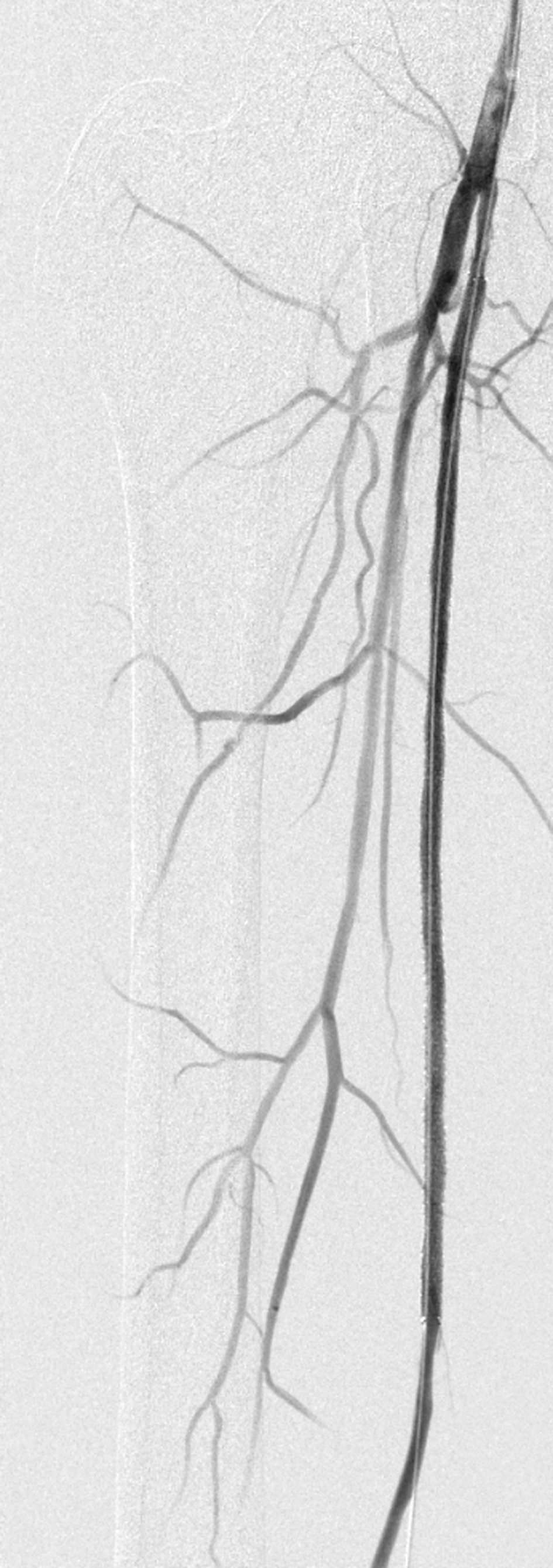 Abb. 2: Mit einem medikamentenbeschichteten Ballon ließ sich der langstreckige Verschluss der A. femoralis superficialis öffnen. 