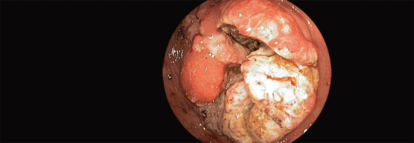 Ein Kolonkarzinom kann zu einem mechanischen Ileus führen.