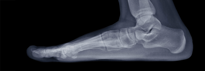 Wer keinen Röntgenblick hat, dem hilft bei der Diagnose Pes planus der Dreiseitenblick: Betrachten Sie den Fuß von der Seite, von oben und von hinten.