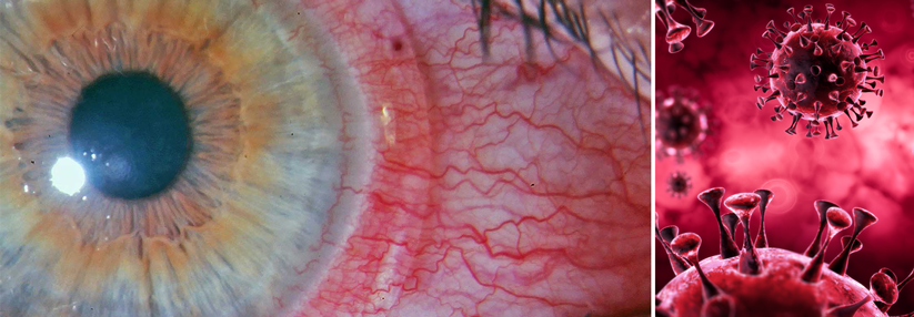 COVID-19? Kontaktlinsen raus! Bei hochfieberhaftem Infekt droht das Tight-Lens-Syndrom.