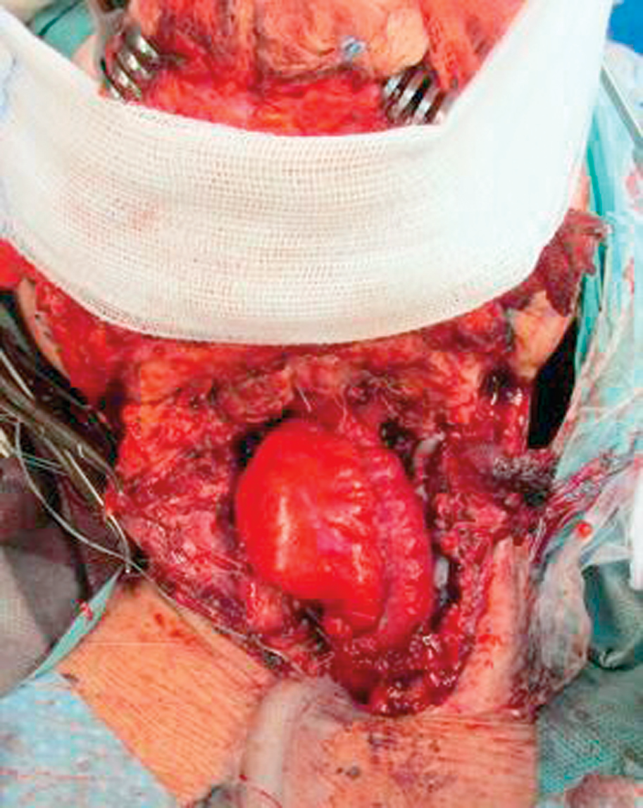 2. Zur Rekonstruktion des oberen Digestivtrakts verwendeten die Kollegen ein 12 cm großes Transplantat aus dem Jejunum.