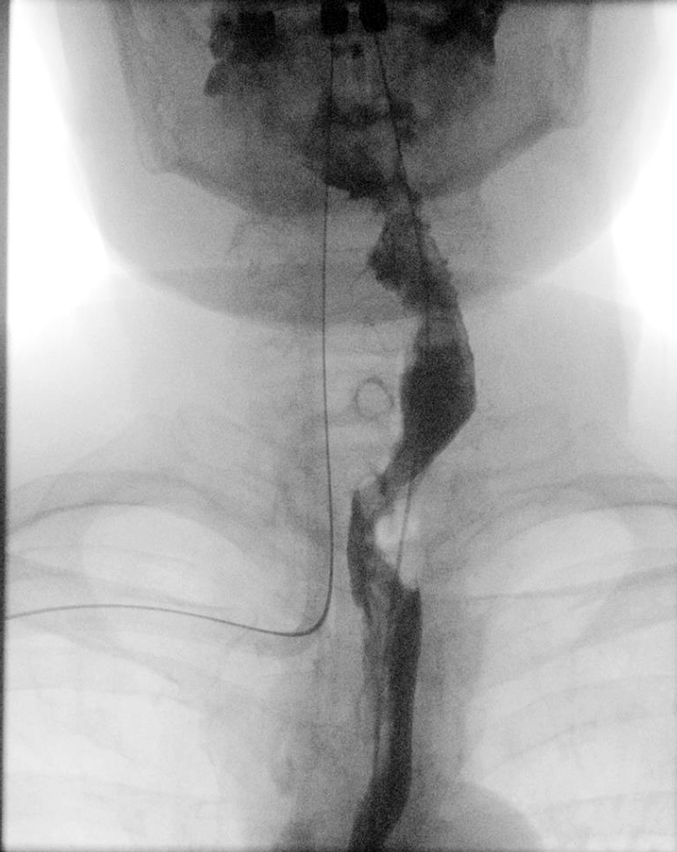 3. 14 Tage nach dem Eingriff stellte sich der obere Verdauungstrakt im Röntgen-Breischluck regelrecht dar.