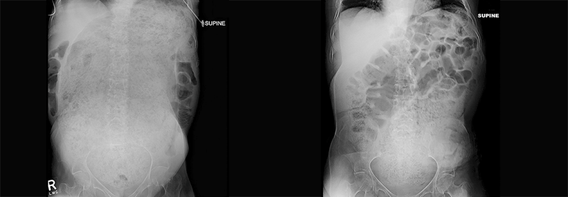 Die körperlich und geistig behinderte Frau war sprichwörtlich bis zum Rand voll mit Fäzes (links). Mit Stoma und Einläufen gelang es, wieder Platz zu schaffen (rechts).