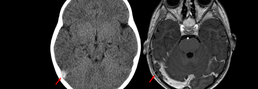 Sinusvenenthrombose in der Computertomographie ohne Kontrastmittel (links) und in der Kernspintomographie T1 mit Kontrastmittel (rechts) beim gleichen Fall.