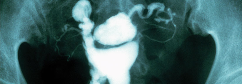 Bei dieser Patientin haben Schleimhautzellen aus der Gebärmutter beide Eileiter verstopft. Sichtbar gemacht mittels Hysterosalpingographie.