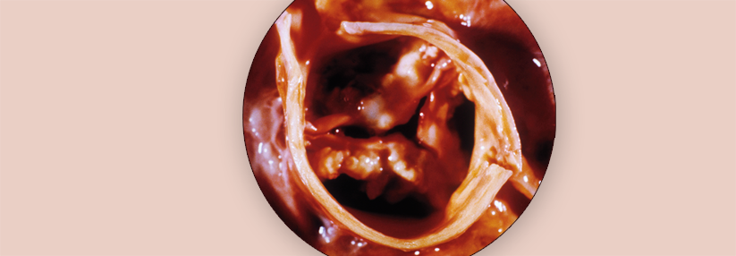 Diese Aortenklappe ist deutlich verändert und stenosiert. Bei dem Patienten war eine Mönckeberg-Sklerose bekannt.