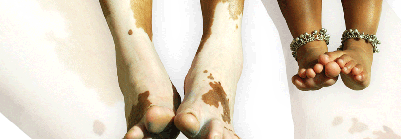 Über eine einmal tägliche topische Therapie konnten Patienten mit Vitiligo ihre Haut zur Repigmentierung bringen. (Agenturfoto)